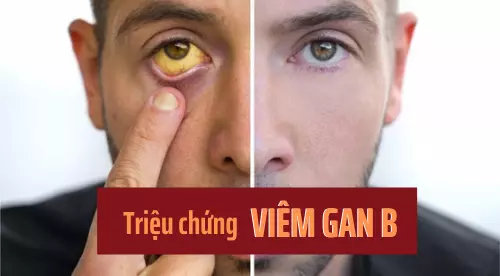 Viêm gan B là gì? Những triệu chứng viêm gan B bạn cần biết